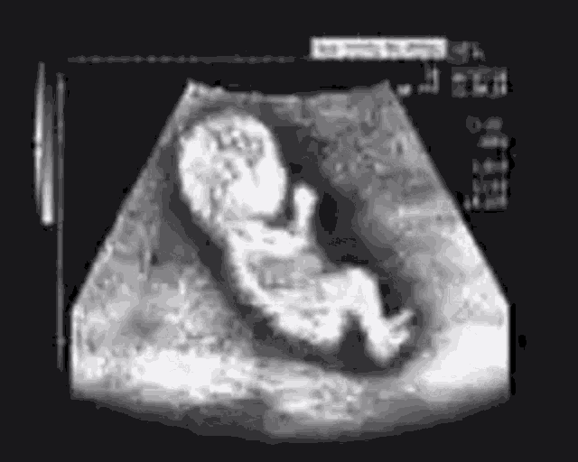 Dancing Baby Ultrasound GIFs Tenor