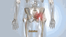 Lower Back Pain Sciatica GIF - Lower Back Pain Sciatica Sciatic Nerve GIFs