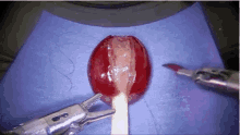Surgery Grape GIF - Surgery Grape Surgeryonagrape GIFs