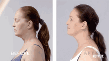 Before And After Skin Decision GIF - Before And After Skin Decision Saggy Skin GIFs
