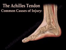 Achilles Tendon Injury Common Causes GIF - Achilles Achilles Tendon Achilles Tendon Injury GIFs