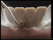 dentist plaque bad teeth clean teeth before and after