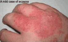 Eczema GIF - Eczema Dry Skin Treatment GIFs