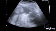 Ultrasound GIF - Ultrasound GIFs