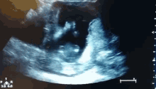 Clapping Ultrasound Baby GIF - Ultrasound Baby Clap GIFs