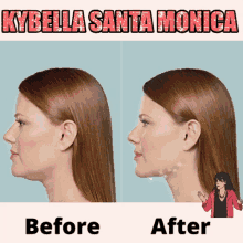 Kybella Fillers GIF - Kybella Fillers Botox GIFs