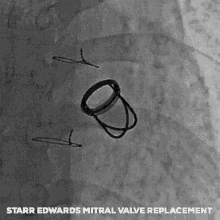 Starr Edwards Mechanical Valve GIF - Starr Edwards Mechanical Valve Cardiology GIFs